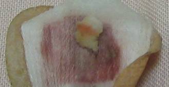 いぼ、イボ、画像、写真